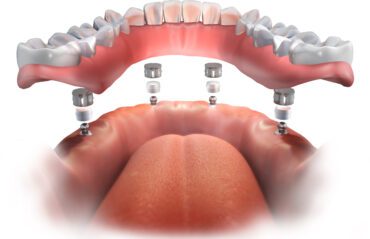 Implant Stabilized Denture