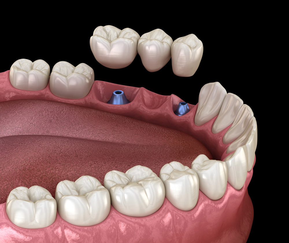 tooth bridge
