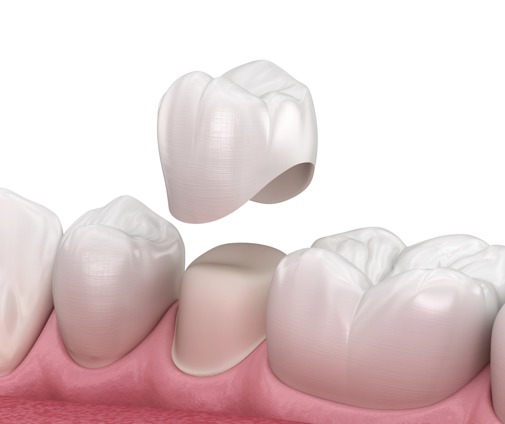 dental cap